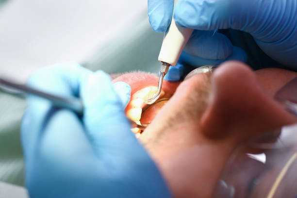 Best Emergency Wisdom Tooth Extraction in Kill Devil Hills, NC